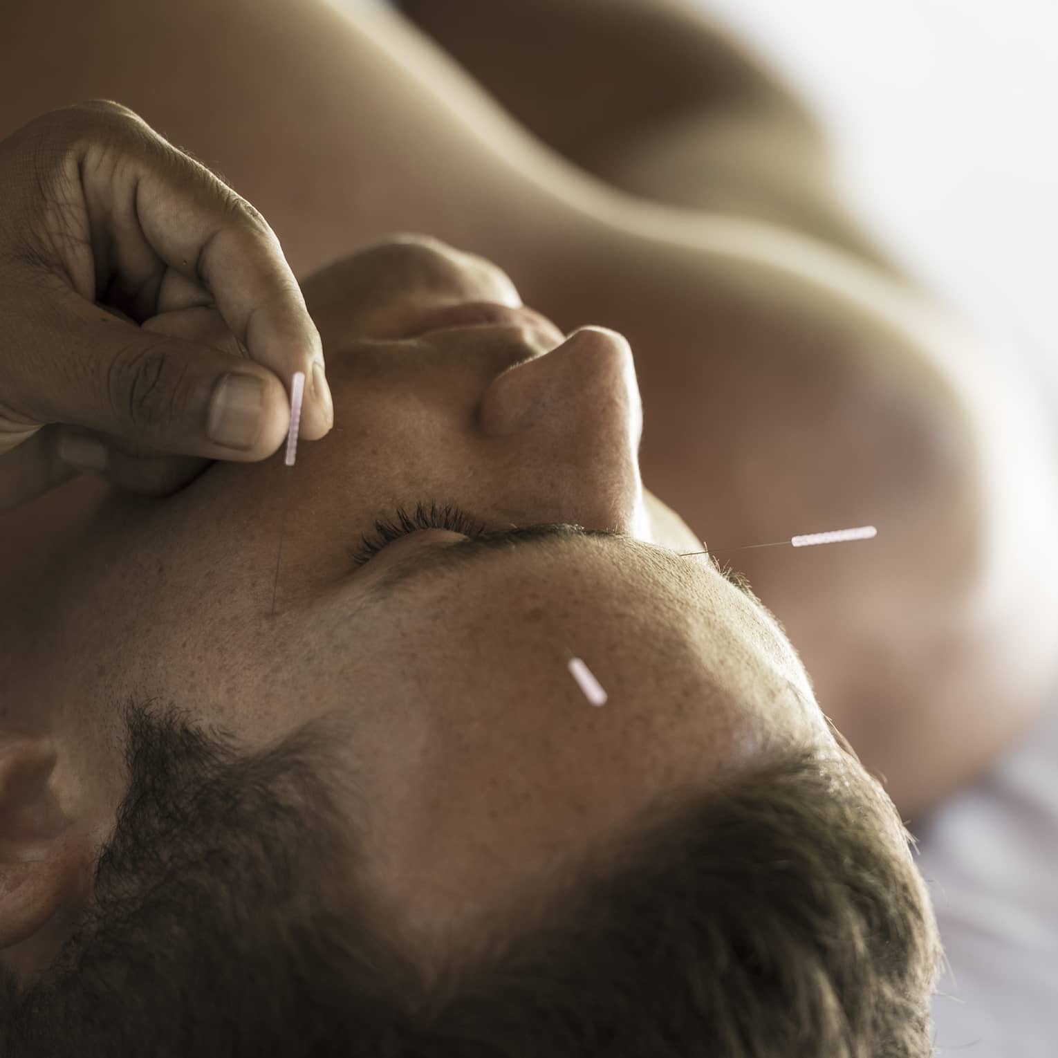 Close up of a man's face as he receives an acupuncture treatment